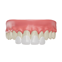 Veneers Treatment: Custom-Ceramic Covers at Bright Way Dental Clinic, Dubai.