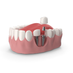 Immediate Implant Procedure at Bright Way Dental Clinic, Dubai.