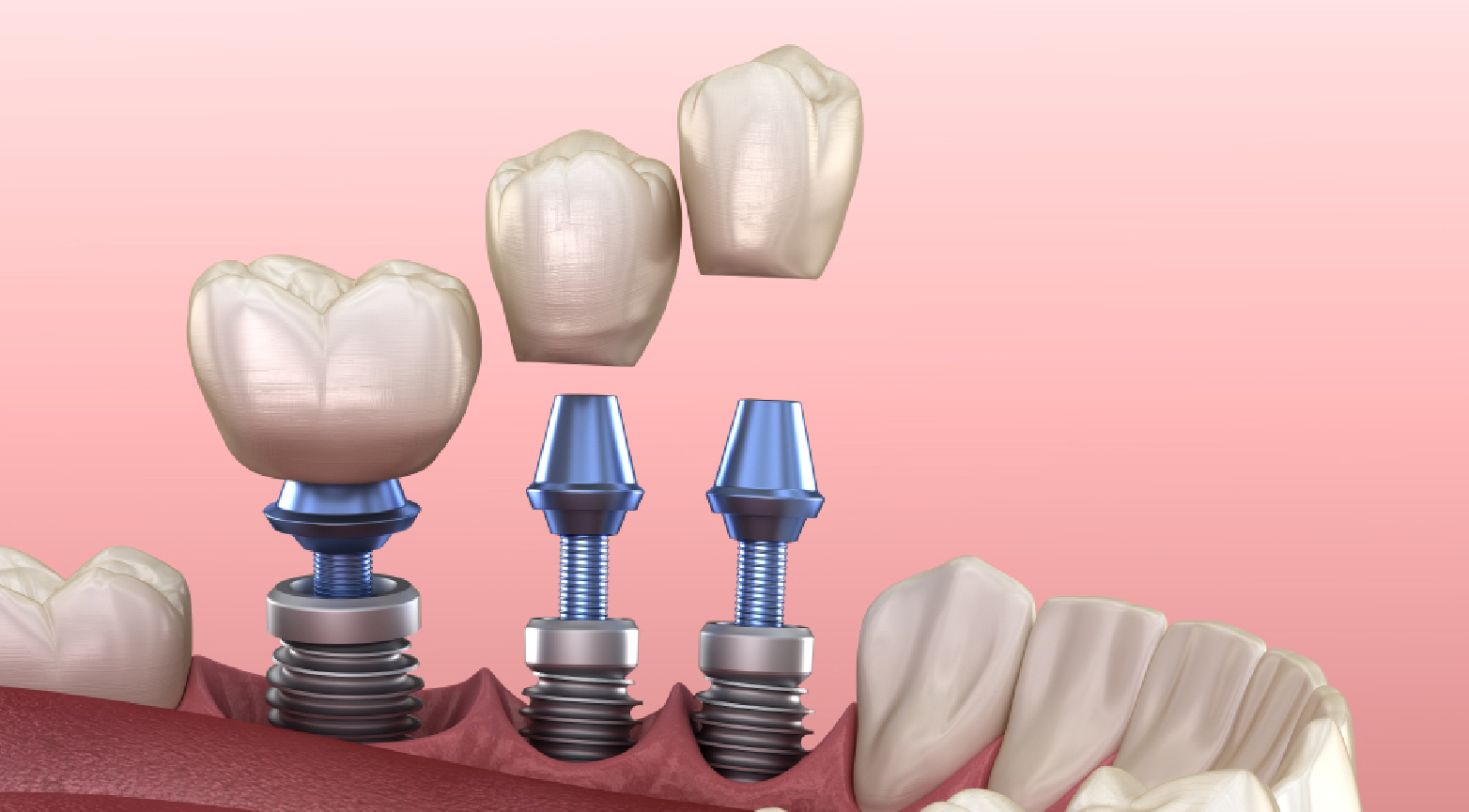 Dental Implant Treatment: Bright Way Dental Clinic, Best Dental Clinic for Dental Implants in Dubai.