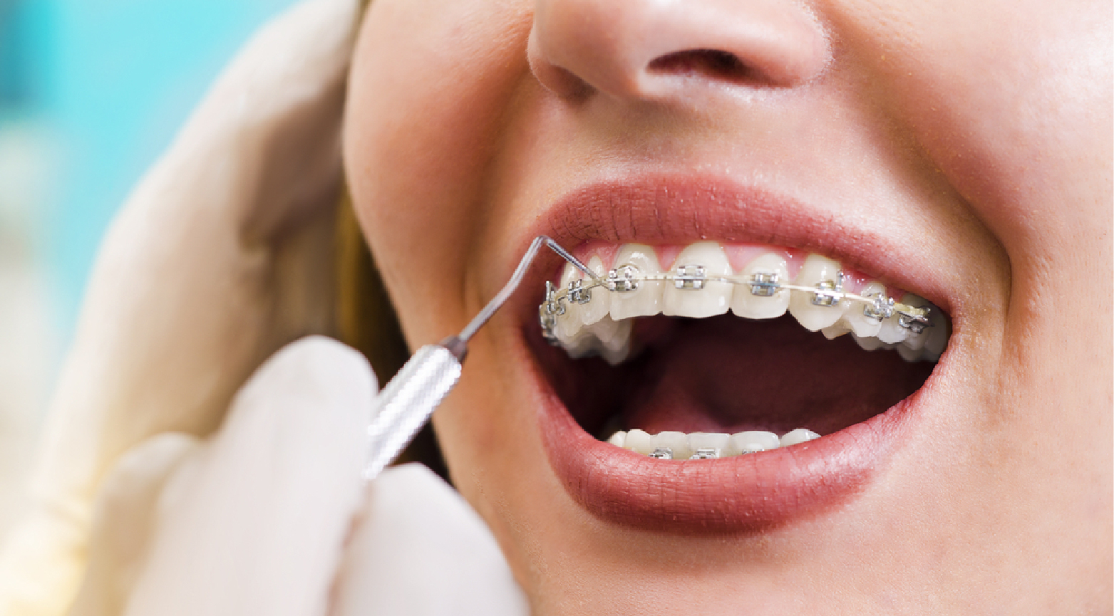 Orthodontics Treatment: Bright Way Dental Clinic, Best Dental Clinic for Orthodontics in Dubai.