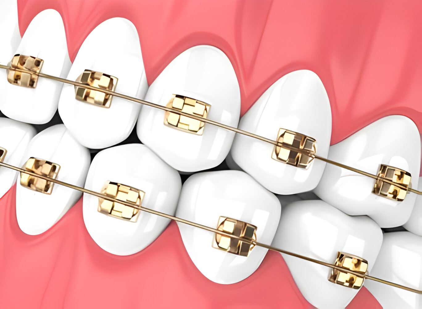 Orthodontic Solutions at Bright Way Dental Clinic.