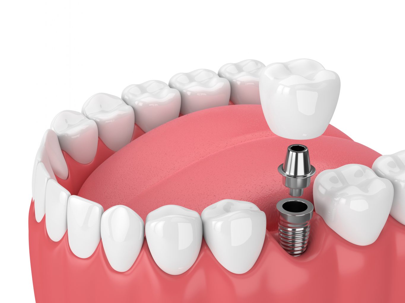 Prosthodontics Services at Bright Way Dental Clinic.