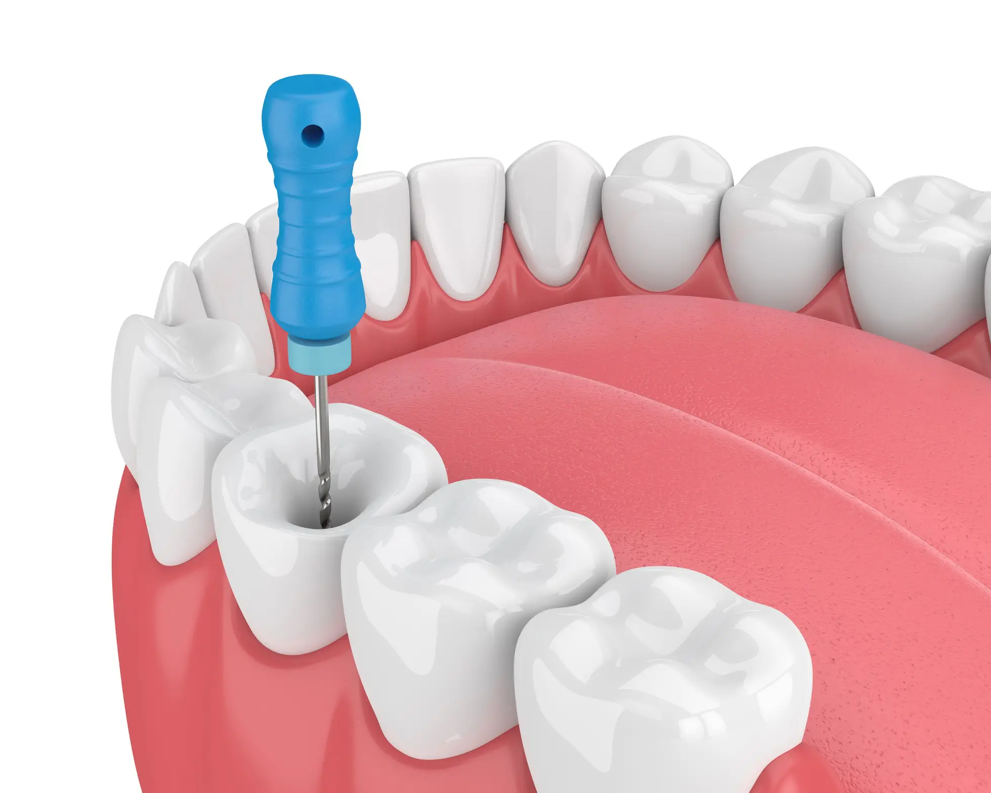 Root Canal Treatment Procedure at Bright Way Dental Clinic.