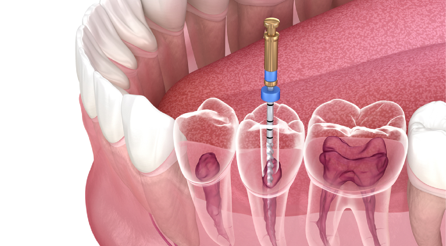 Root Canal Treatment: Bright Way Dental Clinic, Best Dental Clinic in Dubai.