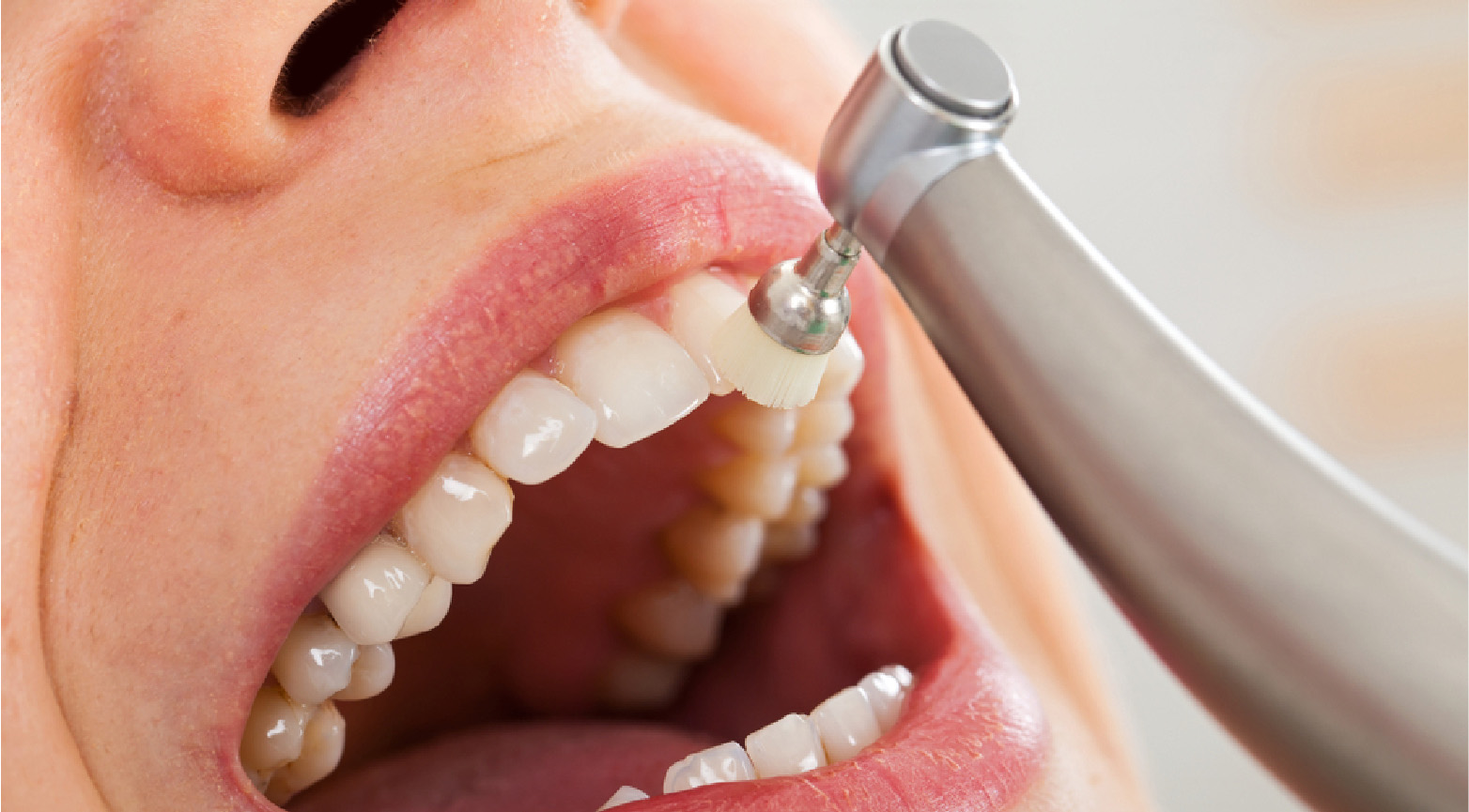 eeth Cleaning and Gum Treatment: Bright Way Dental Clinic, Best Dental Clinic in Dubai.