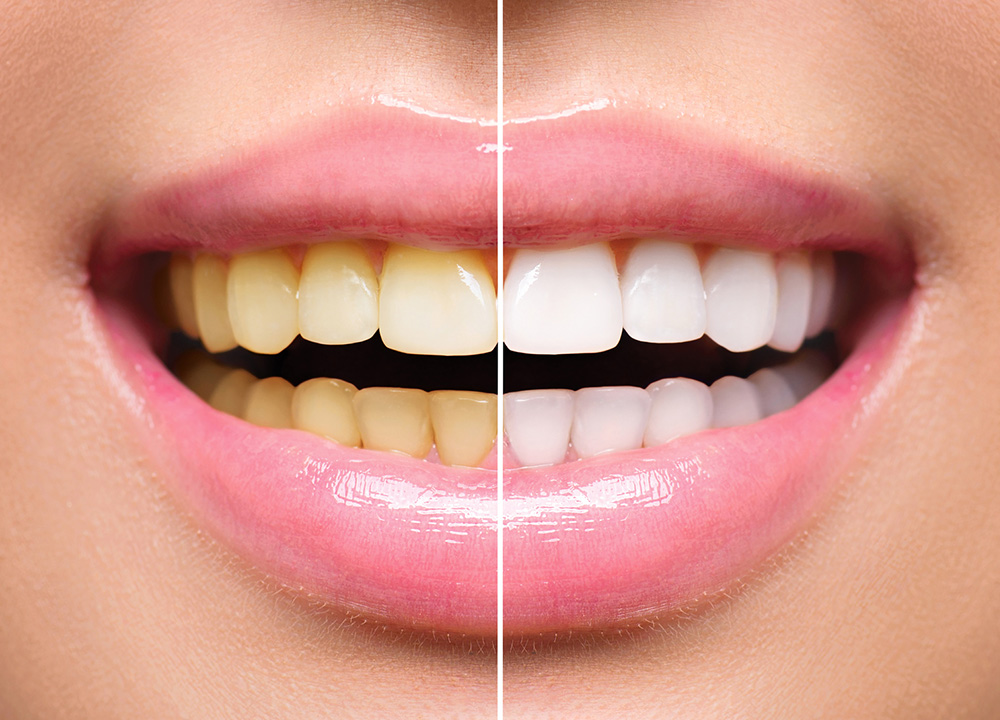 Professional Teeth Whitening Treatment at Bright Way Dental Clinic.