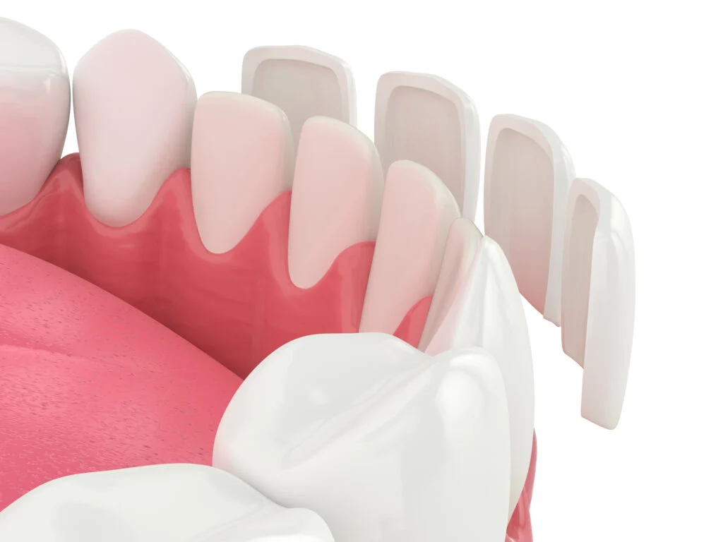 Custom-Made Veneers at Bright Way Dental Clinic