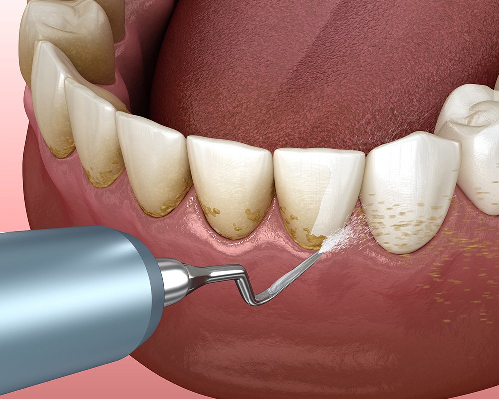 Teeth Cleaning and Gum Treatment Procedure at Bright Way Dental Clinic.