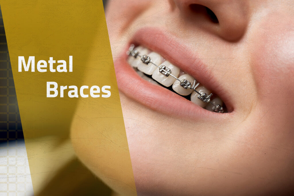 "Comparison of traditional braces vs clear aligners (Invisalign) at Bright Way Dental Clinic, Dubai."