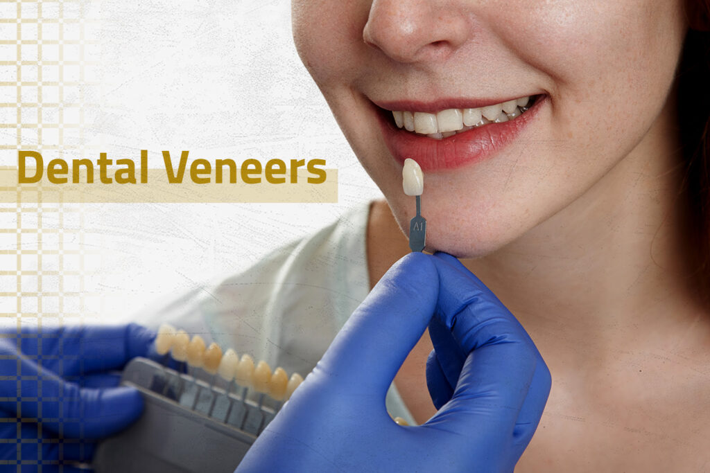 Custom-made dental veneers for a Hollywood smile at Bright Way Dental Clinic, Dubai