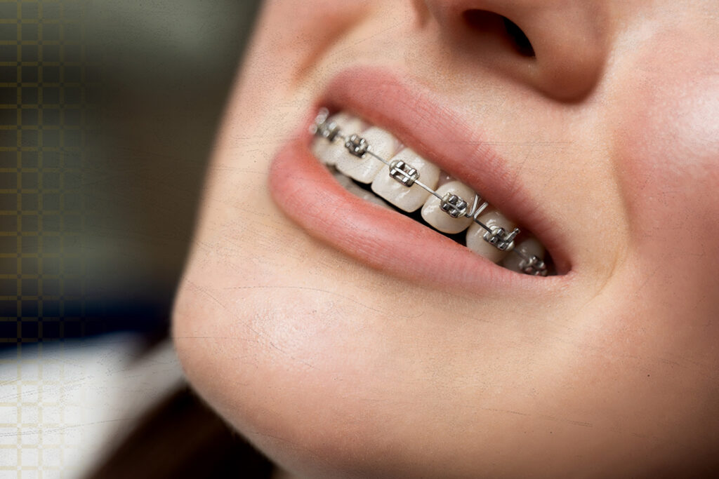 Close-up view of traditional metal braces on teeth, featuring stainless-steel brackets, wires, and elastic bands.