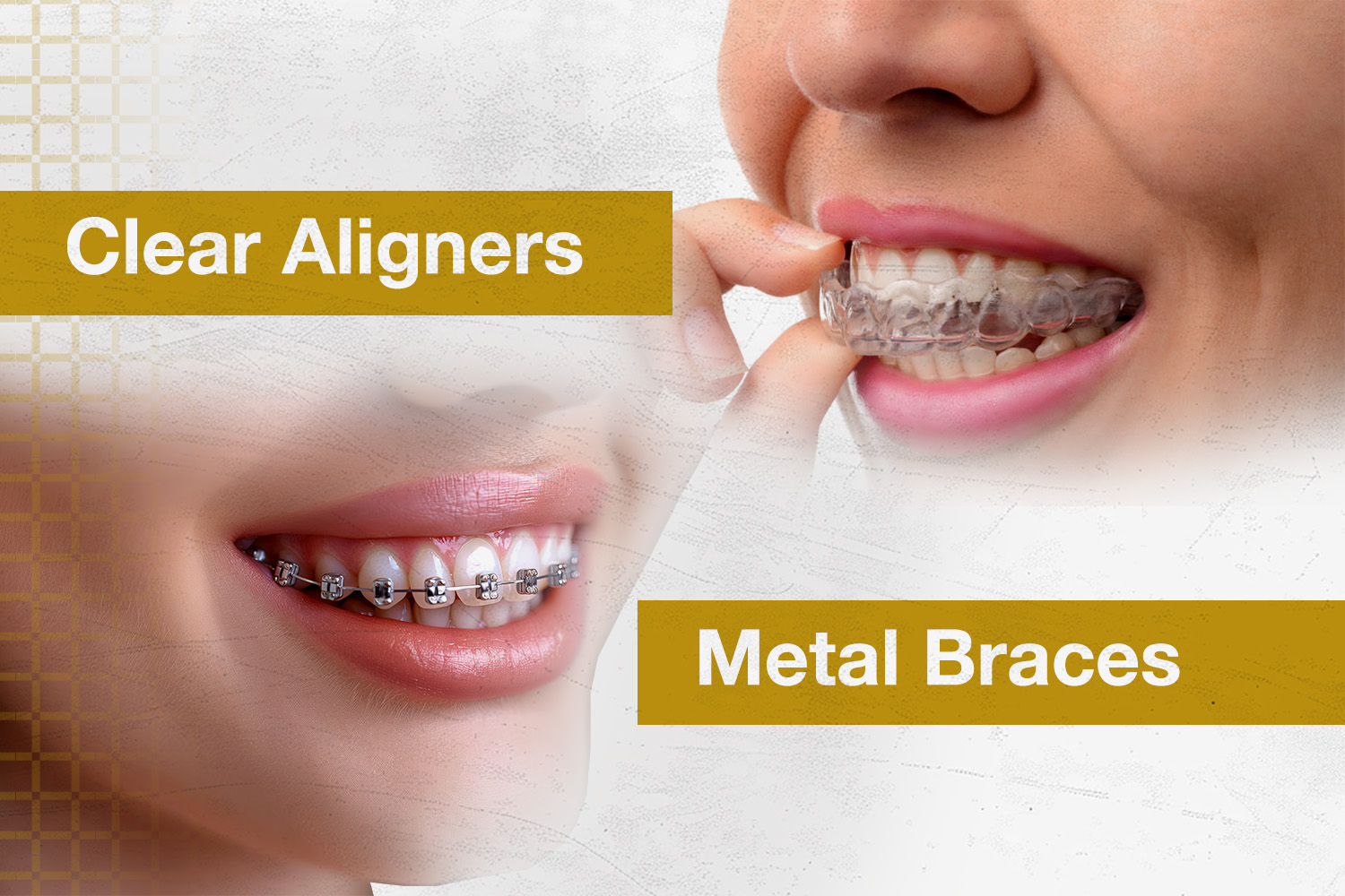 A split image comparing clear aligners on the right with traditional metal braces on the left, showcasing two orthodontic options for teeth alignment.