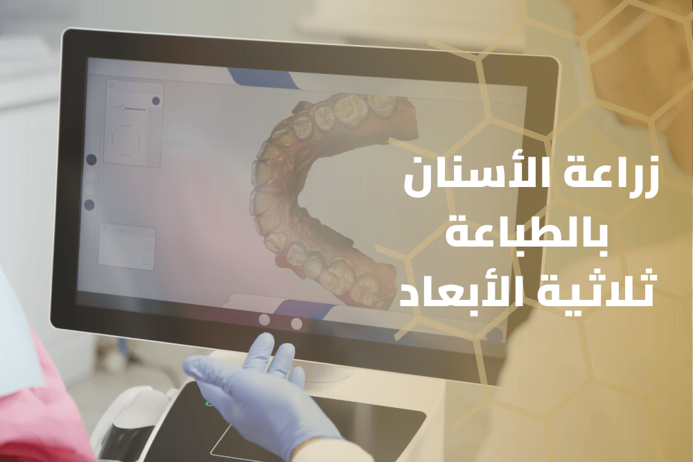 زراعة الأسنان بالطباعة ثلاثية الأبعاد باستخدام مواد مثل التيتانيوم توفر تخصيصًا أعلى ودقة متناهية في علاج الأسنان.