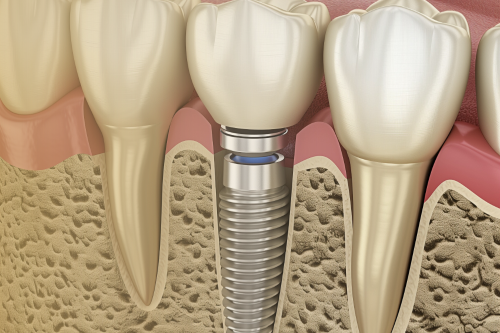 Dental implants with artificial roots made of biocompatible materials for natural-looking and efficient teeth replacement